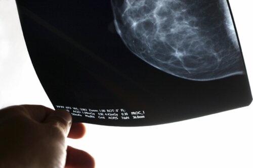 SEIN MAMOGRAMME CANCER